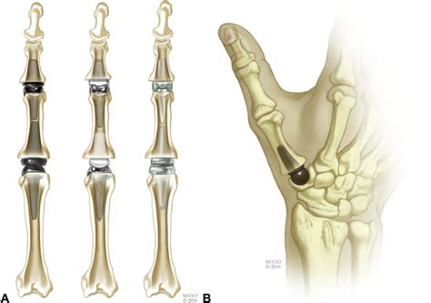 Implant Arthroplasty for Proximal Interphalangeal, Metacarpophalangeal ...