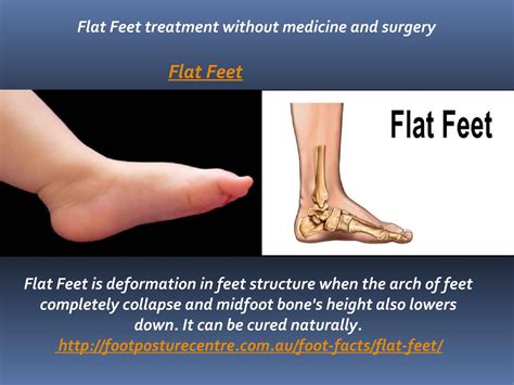 Flat Feet treatment without medicine and surgery by Foot Posture Centre