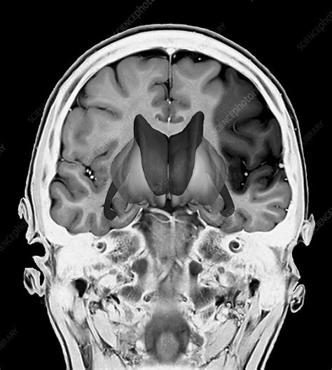 Brain damage due to a stroke, MRI scan - Stock Image - C037/2978 ...