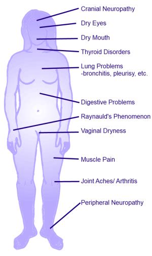 Sjogren's Syndrome - Physiopedia