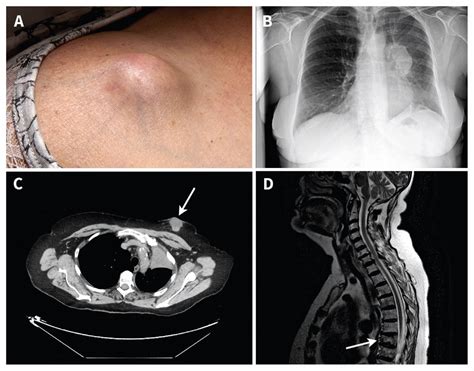 How Often Are Lung Nodules Cancerous - CancerWalls