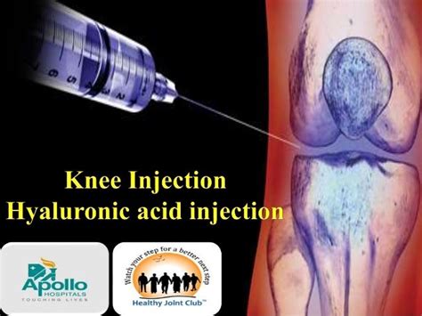 Knee Injection Anatomy