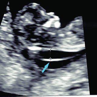 First trimester ultrasound showing fetal thickened nuchal translucency... | Download Scientific ...