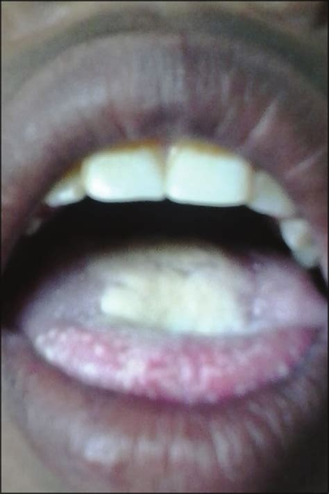 Hyperplastic candidiasis over the tongue | Download Scientific Diagram