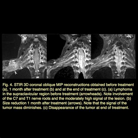 MRI BLOG: Brachial Plexus MRI (II/II)