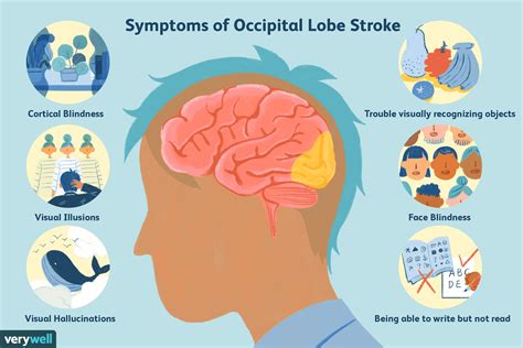 The Effects of an Occipital Lobe Stroke
