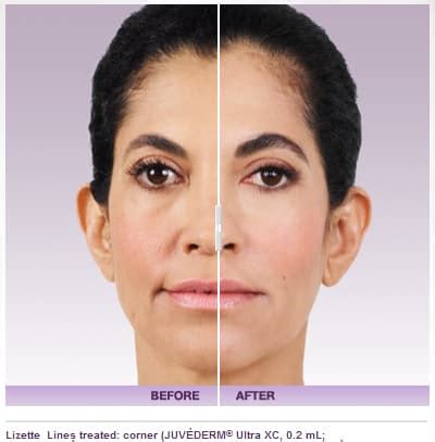 Juvederm Injectable Filler Before and After Photos | Los Angeles | Pasadena