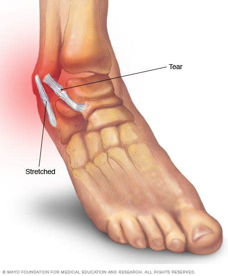 Tendonitis - Idaho Foot & Ankle Center