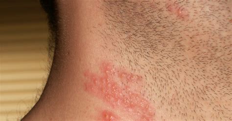 Dr medico : ALLERGIC REACTION SKIN RASH TREATMENT