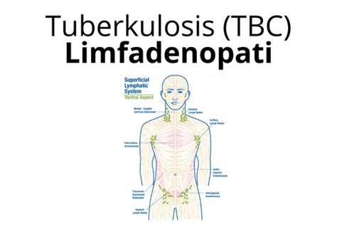 Tuberkulosis (TBC) Limfadenopati | Yayasan KNCV Indonesia