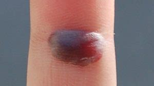 Blood Blister: Causes, Symptoms, Diagnosis, Treatment, Prevention ...