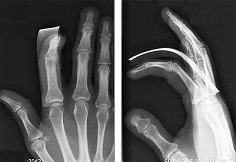 Avulsion Fracture Finger