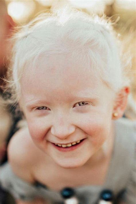 white hair white eyelashes child albino albinism red eyes pale skin not ...