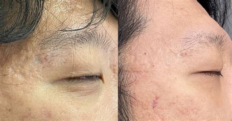 383- Fraxel Laser for Acne Scars - NicholsMD of Greenwich