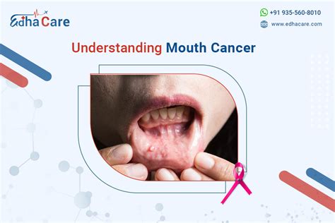 Mouth Cancer: Causes, Symptoms, and Diagnosis - EdhaCare