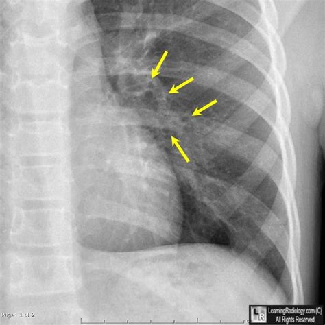 Peribronchial Cuffing Bronchiolitis Peribronchial cuffing | Reactive airway disease, Radiology ...