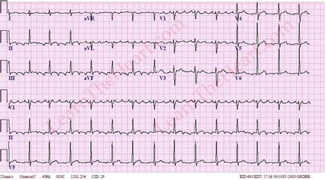 Ecg Atrial Flutter 1 1 Block Dicas | Hot Sex Picture