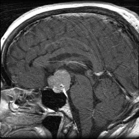 Suprasellar meningioma | Image | Radiopaedia.org