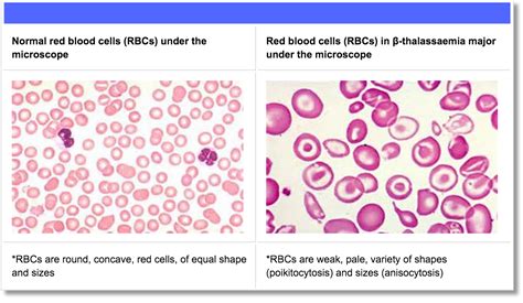 Beta Thalassaemia – TIF