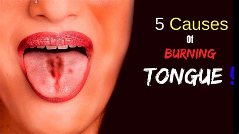 What Can Cause Burning Tongue And Lipsticks | Lipstutorial.org