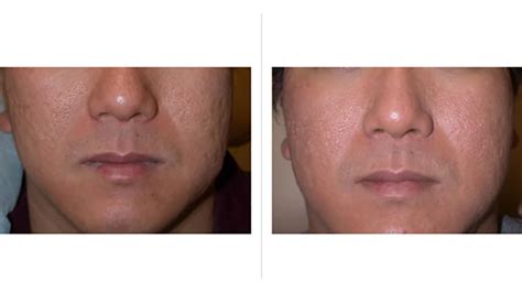 Laser Treatment For Acne Scars Cost In Bangalore - change comin