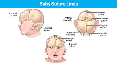 Cranial Disorders and Head Shape | Mount Sinai - New York