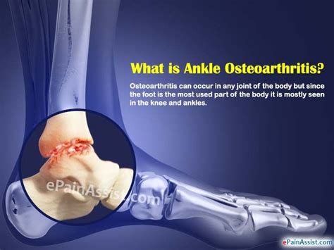 Ankle Osteoarthritis: Causes, Symptoms, Treatment, Recovery, Diagnosis #ankleOst…