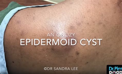 An OOZY Epidermoid Cyst – 33 Recipes | Epidermoid cyst, Cysts, Natural acne treatment