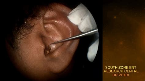 IMPACTED EAR WAX REMOVAL WITH HOOK HD - YouTube