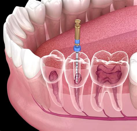 Root Canal Treatment Brentwood TN - Hallmark Dental