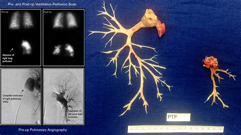 Operative Technique in Pulmonary Thromboendarterectomy - Operative ...