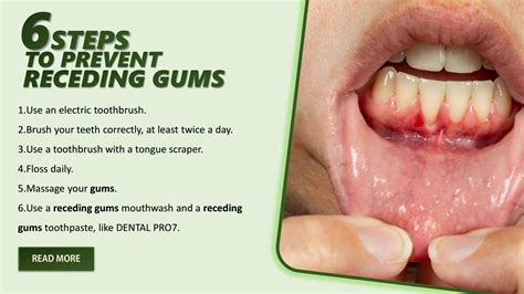 Prevent Receding Gums Getting Worse by DavidMauldin - Issuu