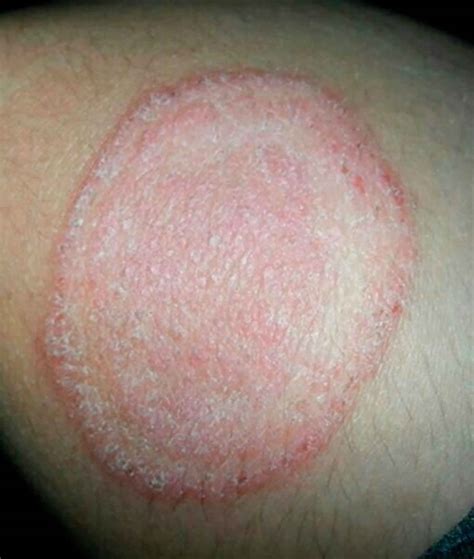 Tinea corporis causes, symptoms, diagnosis & treatment