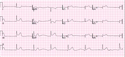 Dr. Smith's ECG Blog: Inferior STEMI with AV Block, Cardiogenic Shock and ST elevation in V1