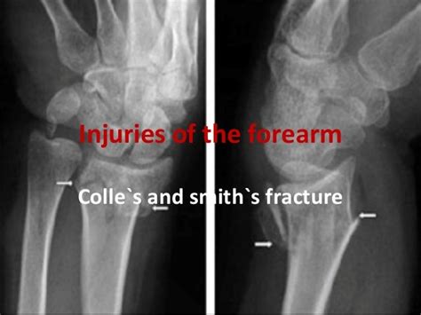 Colle`s and smith`s fracture