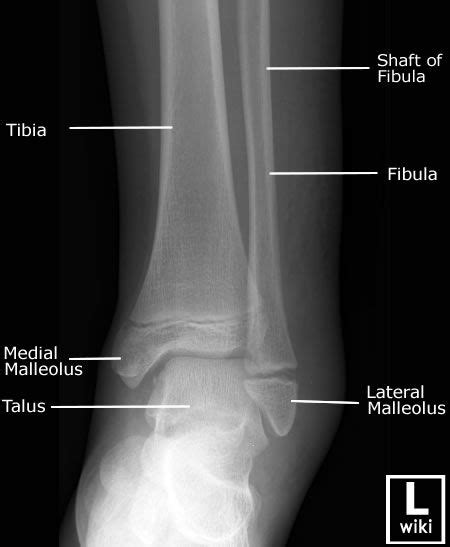 Normal labeled | Pediatric Ankle X Ray Ap radiograph of the pediatric | Ankle anatomy, Medical ...