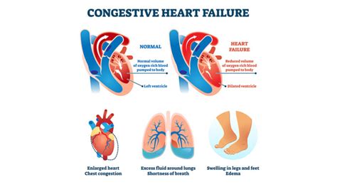 Congestive Cardiac Failure, Causes, Symptoms and Treatment | Dr. Raghu