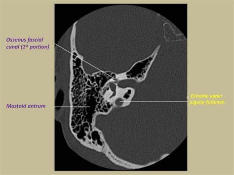 Presentation1.pptx, radiological anatomy of the petrous bone.