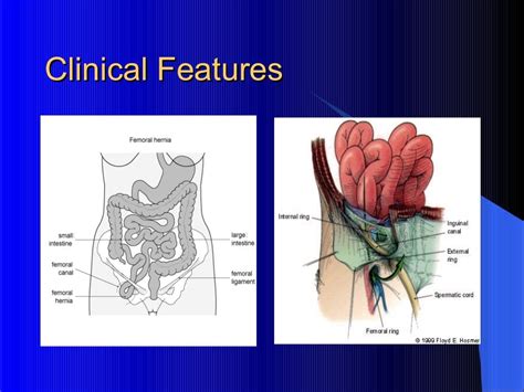 Femoral hernia: A challenging hernia!