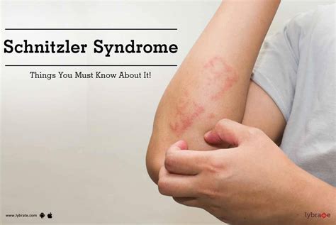 Schnitzler Syndrome - Things You Must Know About It! - By Dr. Manju ...