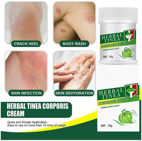 Buy ZUYOKI Herbal Tinea Corporis Cream Tinea Skin Relief Itching Cream,Tinea Versicolor ...