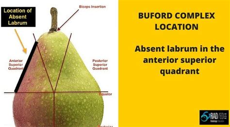 GLENOID LABRUM MRI SIMPLIFIED 3: Buford Complex (not complex at all) - Radedasia