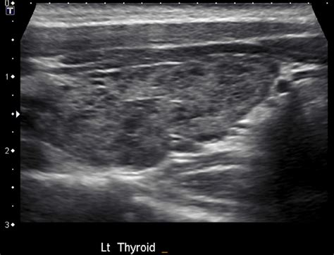 Heterogeneous Thyroid Gland Radiology