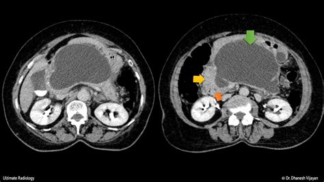 Ultimate Radiology : Pancreatic pseudocyst with duct communication (CT)