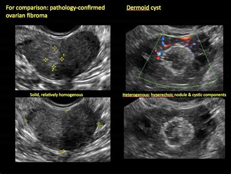 Imaging the endometrioma and mature cystic teratoma | MDedge ObGyn