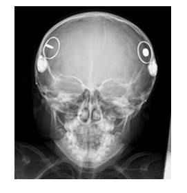 Cochlear Implant Magnet Dislocation Caused by 1.5T MRI: Case Series Study