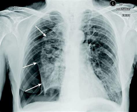 loom Stable poll علاج الاسترواح الصدري في المنزل curly contrast basin