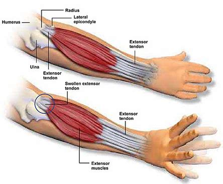 Forearm Pain: A New Treatment For An Old Problem – DRUM! Magazine