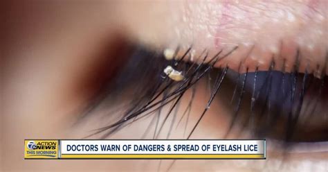 Doctors warn of lice found in eyelash extensions