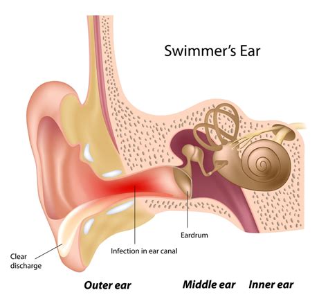 Ear Canal Infection - Net Health Book